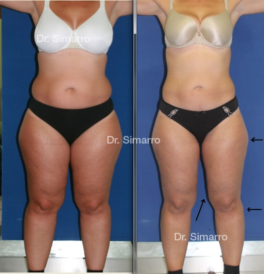 Cirugía de lipedema en muslos: antes y después - Mi Dieta Vegana